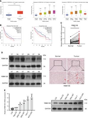 YY1-Targeted RBM15B Promotes Hepatocellular Carcinoma Cell Proliferation and Sorafenib Resistance by Promoting TRAM2 Expression in an m6A-Dependent Manner